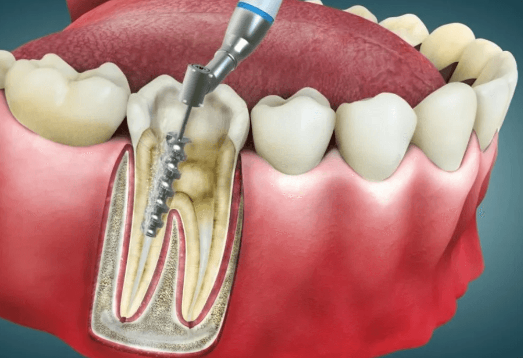 RCT: How Advanced Dental Care Saves Infected Teeth